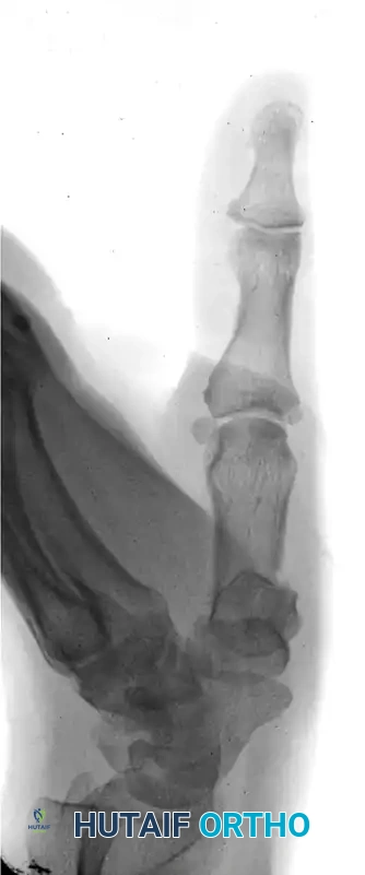 CLOSED PINNING Surgical Diagram