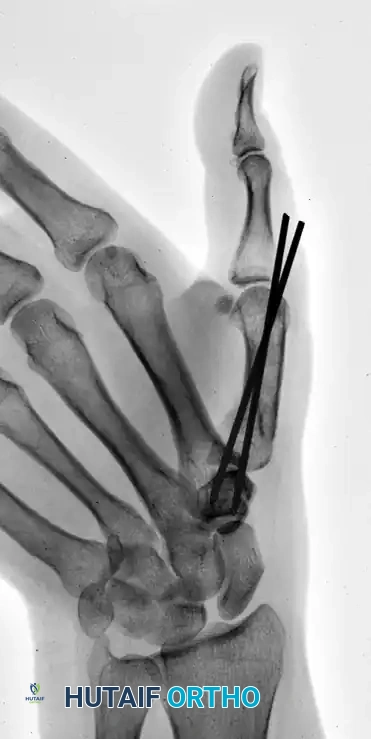 CLOSED PINNING Surgical Diagram