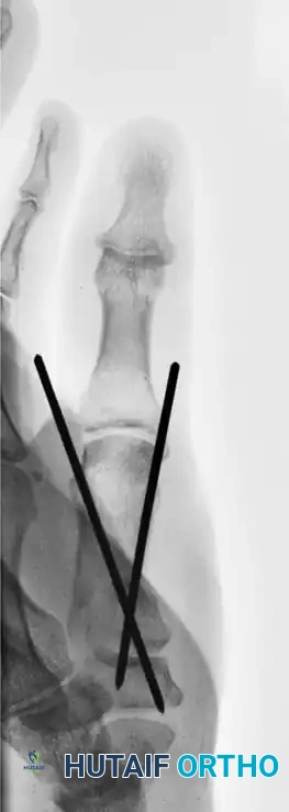 CLOSED PINNING Surgical Diagram