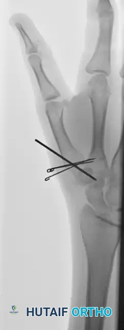 CLOSED PINNING Surgical Diagram