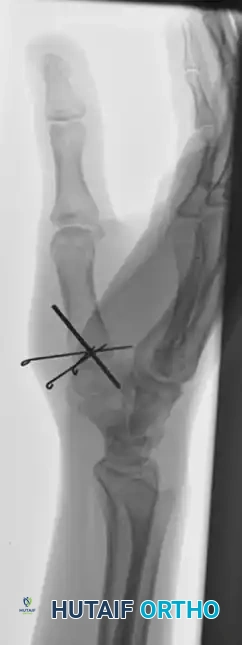 CLOSED PINNING Surgical Diagram