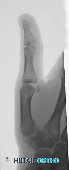 CLOSED PINNING Surgical Diagram
