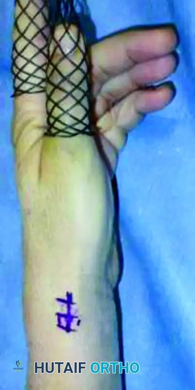 CLOSED REDUCTION AND PERCUTANEOUS PINNING OF DISTAL RADIAL FRACTURE Surgical Diagram