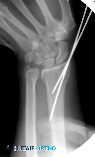 CLOSED REDUCTION AND PERCUTANEOUS PINNING OF DISTAL RADIAL FRACTURE Surgical Diagram