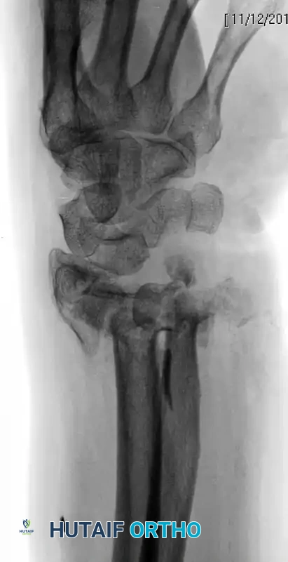 CLOSED REDUCTION AND PERCUTANEOUS PINNING OF DISTAL RADIAL FRACTURE Surgical Diagram