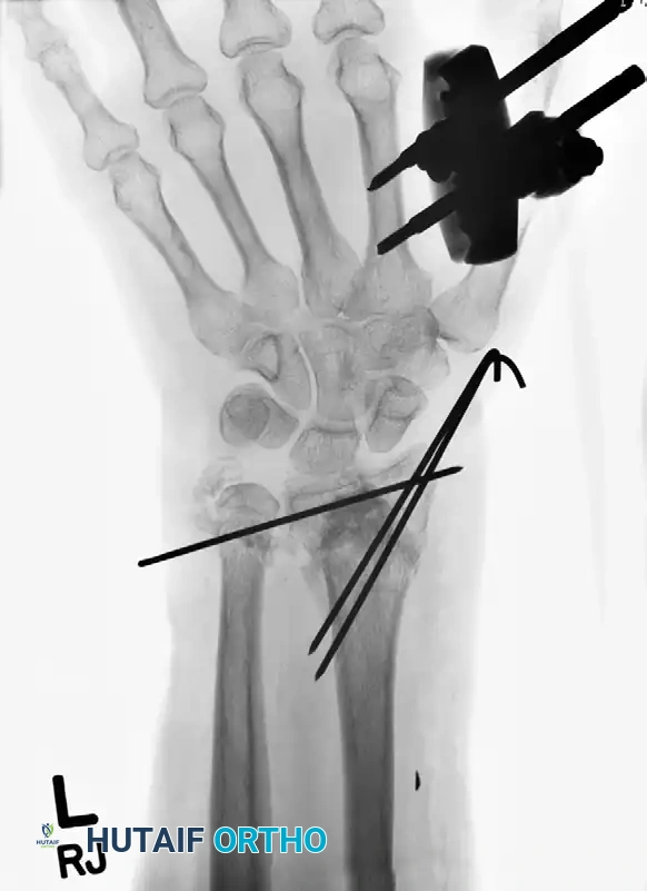 CLOSED REDUCTION AND PERCUTANEOUS PINNING OF DISTAL RADIAL FRACTURE Surgical Diagram