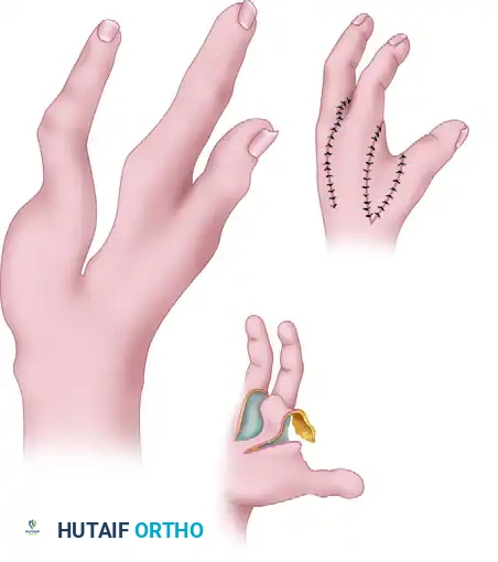 Combined Cleft Closure and Thumb Adduction Contracture Release