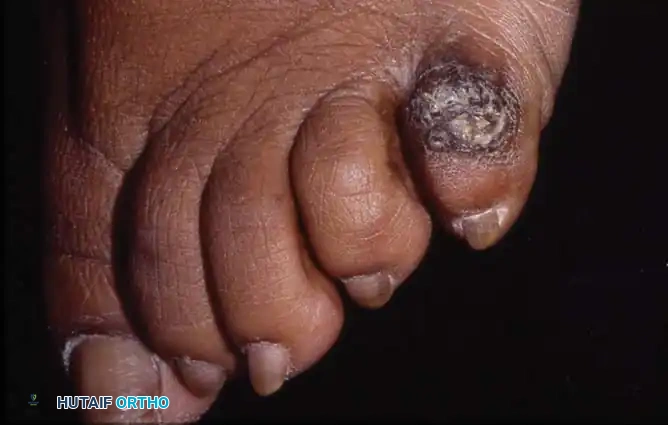 Fig. 80-21 Acutely infl amed hard corn over dorsolateral surface of fi fth toe with swelling, heat, and erythema.