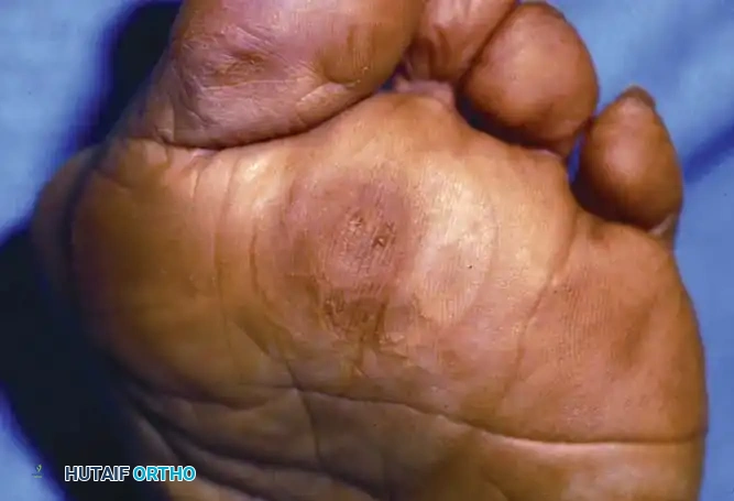 Fig. 80-22 Lesion appeared to be plantar keratosis until pared down to reveal wart.