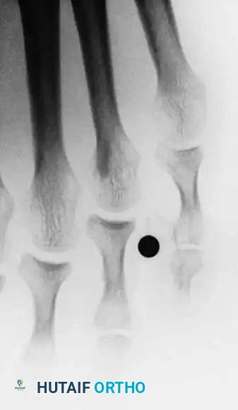 Fig. 80-23 A, Fourth web space interdigital corn. B, Corresponding radiograph with marker overlying corn. Note two-boned fi fth toe and abnormally short fi fth metatarsal. C, Oblique view showing apposition of base of fourth proximal phalanx and head of fi fth proximal phalanx.