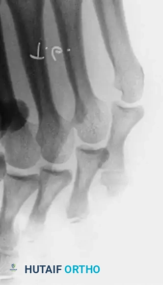 Fig. 80-23 A, Fourth web space interdigital corn. B, Corresponding radiograph with marker overlying corn. Note two-boned fi fth toe and abnormally short fi fth metatarsal. C, Oblique view showing apposition of base of fourth proximal phalanx and head of fi fth proximal phalanx.