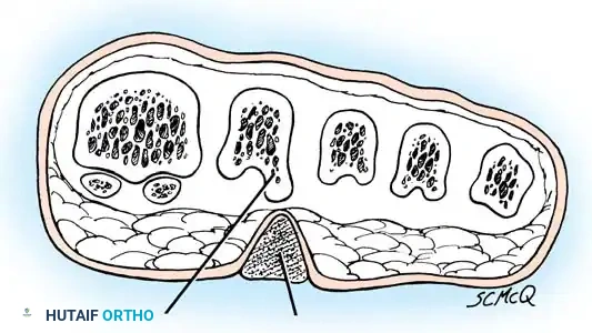 Lateral condyle of metatarsal head A