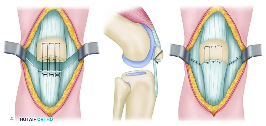 COMMINUTED PATELLAR FRACTURES Surgical Diagram
