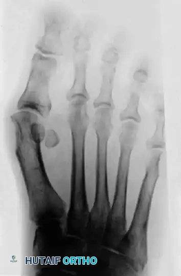 COMPLICATIONS AFTER SURGERY FOR HALLUX VALGUS Surgical Diagram