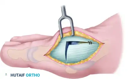 COMPLICATIONS AFTER SURGERY FOR HALLUX VALGUS Surgical Diagram