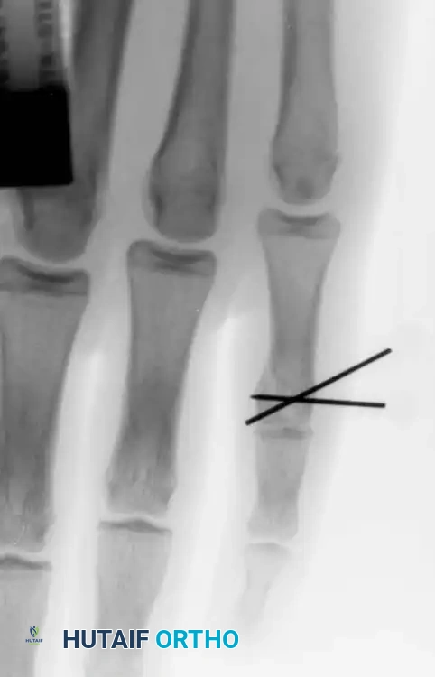 COMPLICATIONS OF HAND FRACTURES Surgical Diagram