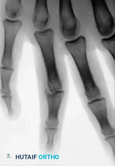 COMPLICATIONS OF HAND FRACTURES Surgical Diagram