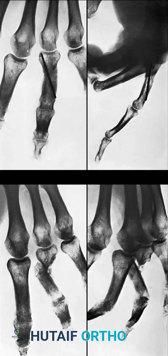 COMPLICATIONS OF HAND FRACTURES Surgical Diagram