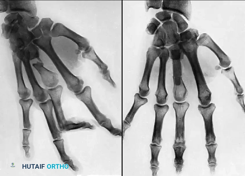 COMPLICATIONS OF HAND FRACTURES Surgical Diagram