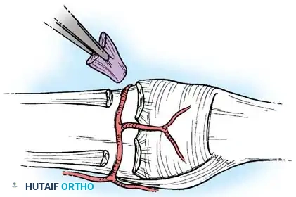 COMPLICATIONS OF HAND FRACTURES Surgical Diagram