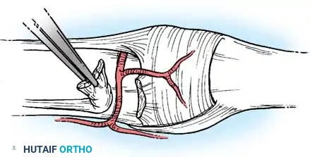 COMPLICATIONS OF HAND FRACTURES Surgical Diagram