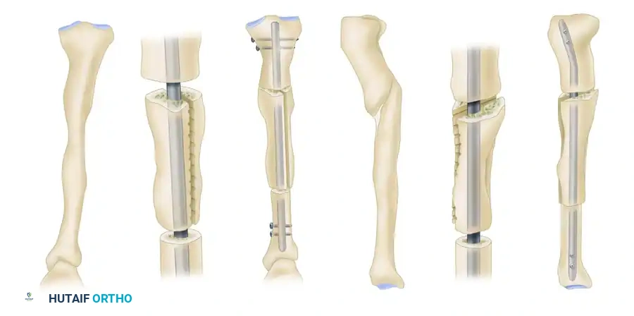 Surgical Management of Tibial Condyle Malunions: A Comprehensive Guide