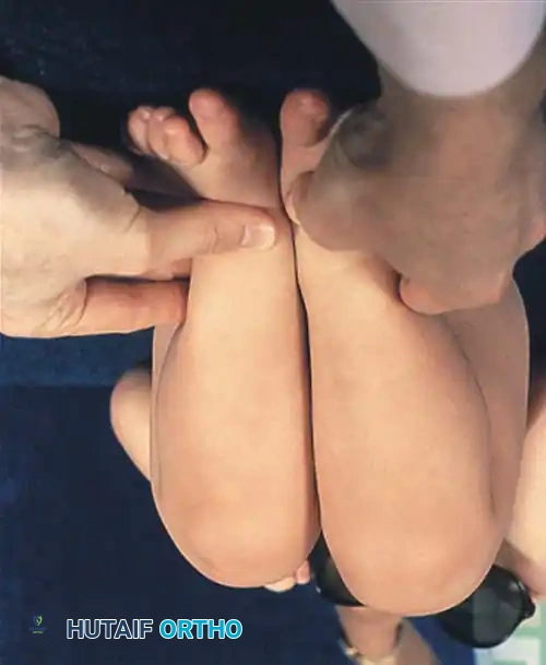 Fig. 27-2 Clinical signs of congenital dislocation of hip in 13-month-old infant. A, Decrease in abduction of right hip with adduction contracture. B, Positive Galeazzi sign with apparent shortening of right lower extremity.