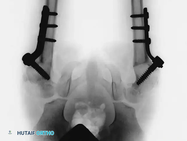 Fig. 27-36 Congenital coxa vara. C, After bilateral subtrochanteric osteotomies and internal fi xation with pediatric hip screw.