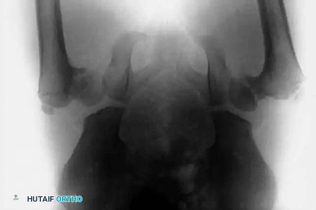 Fig. 27-36 Congenital coxa vara. B, Preoperative radiograph shows neck-shaft angle of less than 90 degrees bilaterally at age 5 years.