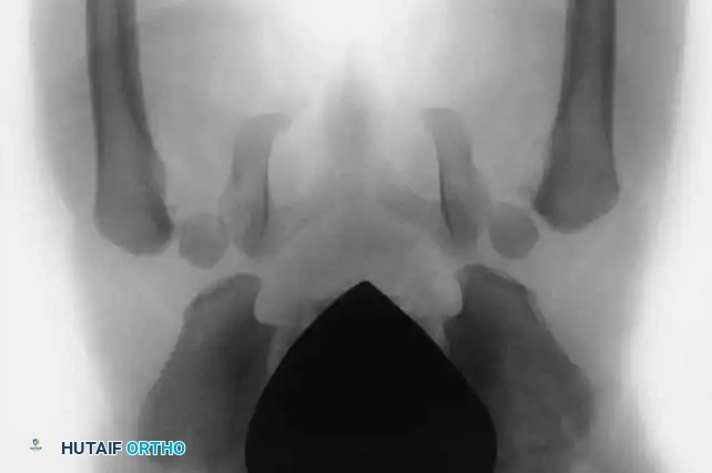 Fig. 27-36 Congenital coxa vara. A, Two-year-old girl with congenital coxa vara.