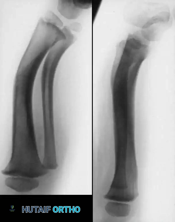 Congenital Angular Deformities & Pseudarthrosis of the Tibia