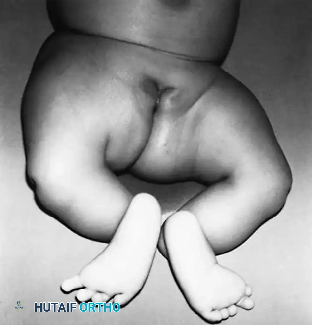 Fig. 26-67 Bilateral tibial hemimelia in 3-month-old girl; note absence of great toe on right foot, severe varus deformities of feet, and fi xed knee fl exion contractures.