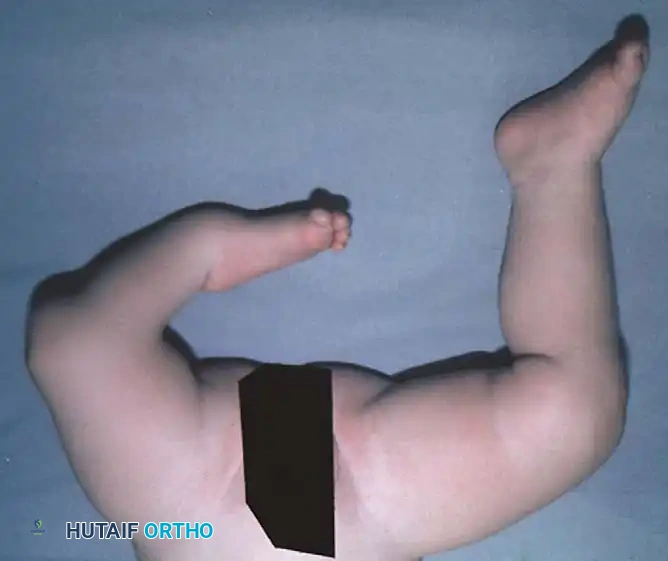 Fig. 26-69 Congenital tibial hemimelia type 1A. A, Clinical appearance. B, Radiographic appearance.