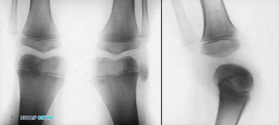 Fig. 26-65 Untreated congenital dislocation of left patella in 5-year-old boy. A, Anteroposterior view shows fi xed lateral dislocation. B, On lateral view, patella appears absent because of superimposed femoral condyles.