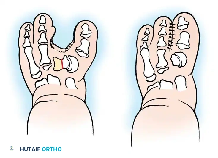Kelikian Procedure Diagram