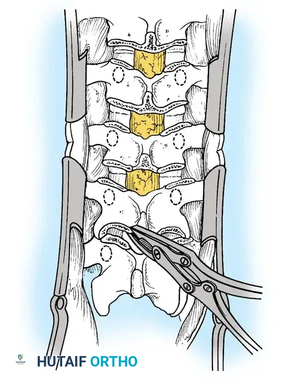 Posterior column shortening B