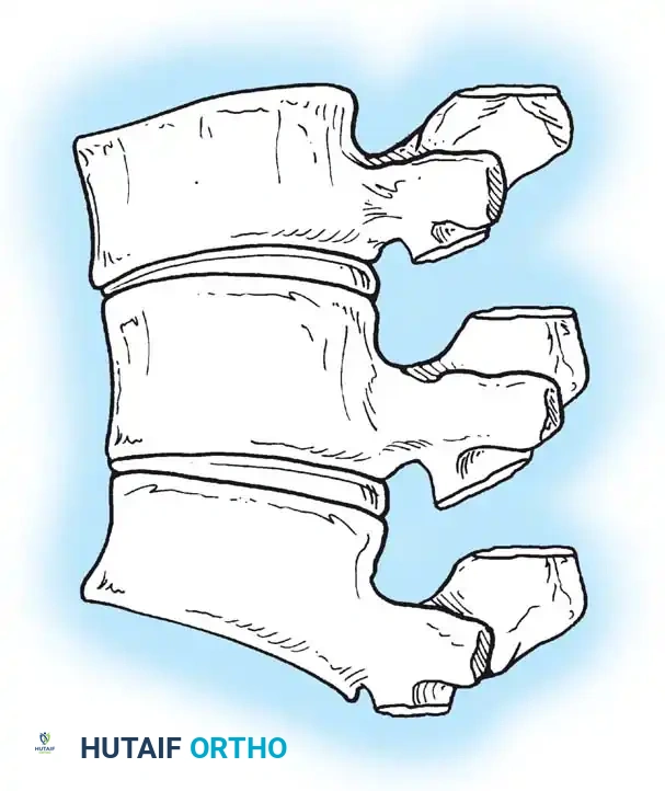 Posterior column shortening C