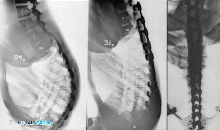 Reduction of kyphosis H-I