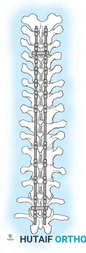 Reduction of kyphosis E-G