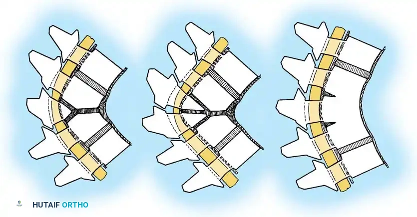 Classification of congenital kyphosis Type I
