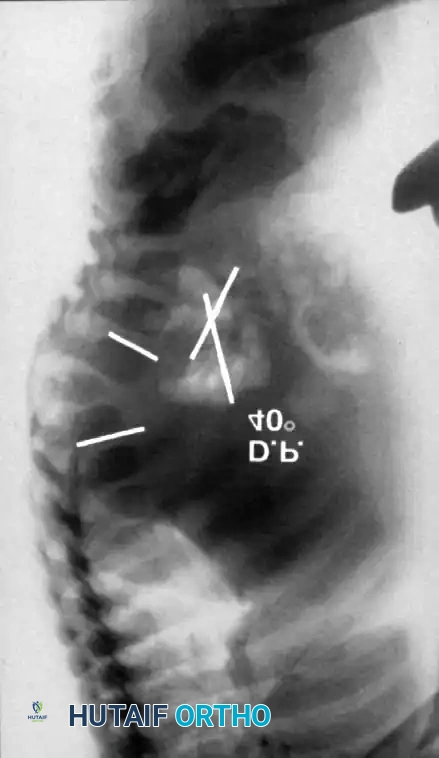Two-year-old child with type I congenital kyphosis
