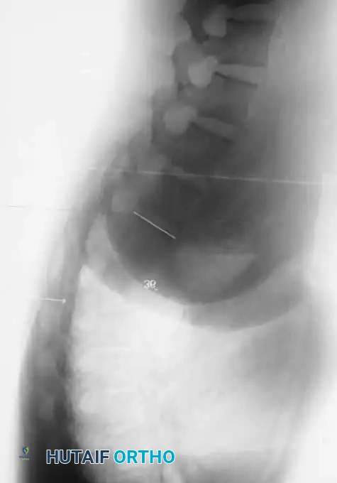 Surgical Diagram: Anterior Approach