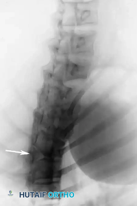 Surgical Diagram: Advanced Osteotomy