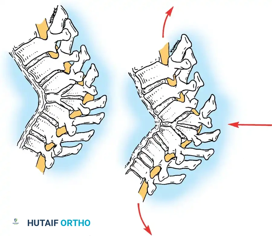 Surgical Diagram: Neural Decompression