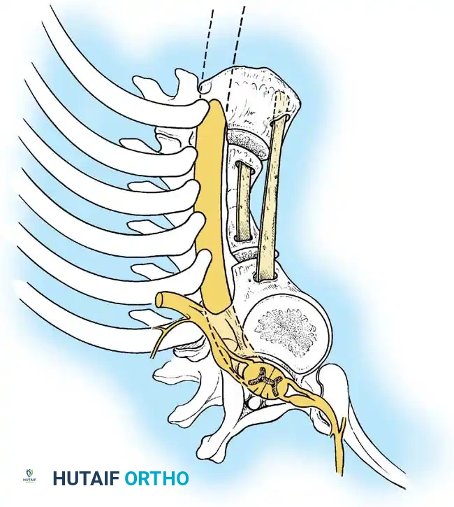 Surgical Diagram: Graft Impaction
