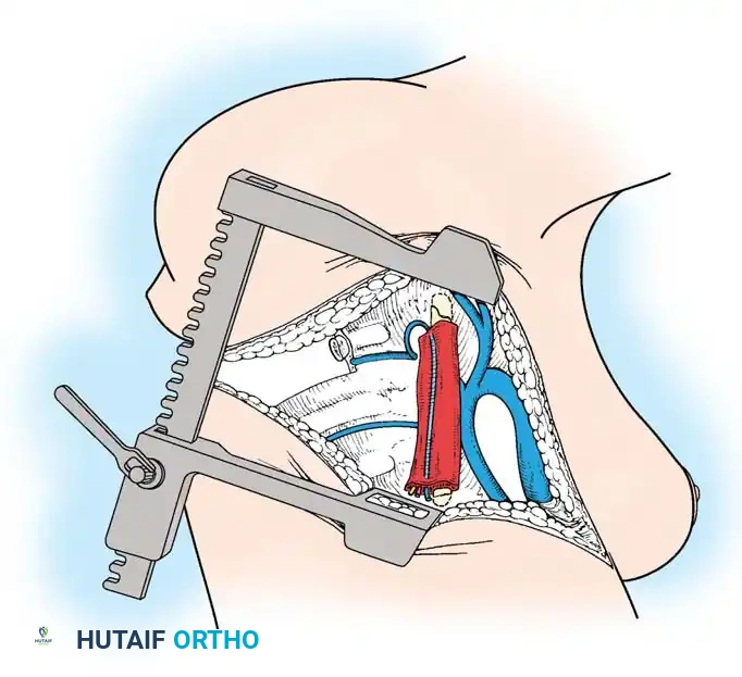 Surgical Diagram: Strut Graft Insertion