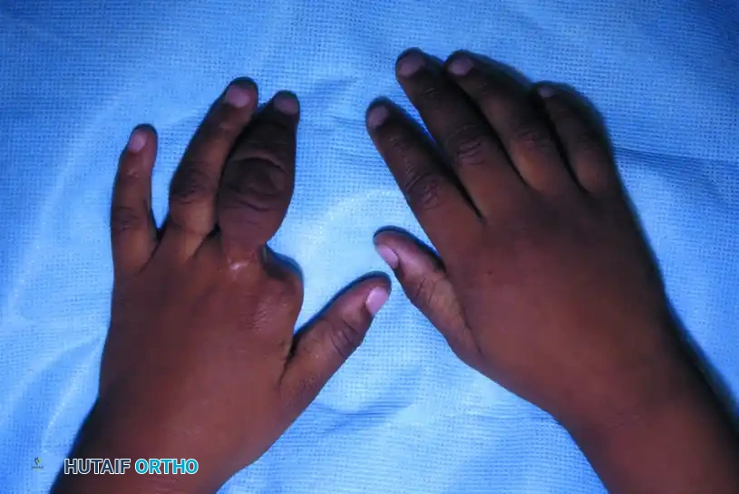 Advanced Surgical Management of Congenital Ring Syndrome