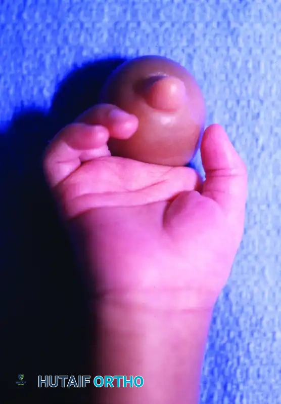 CONGENITAL RING SYNDROME Surgical Diagram