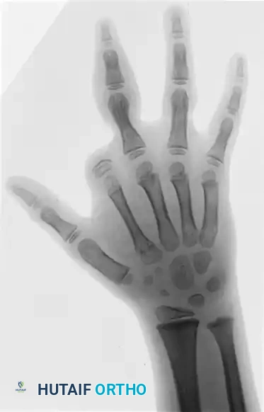 CONGENITAL RING SYNDROME Surgical Diagram