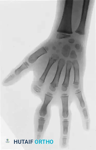 Congenital Ring Syndrome: Surgical Management & Z-Plasty